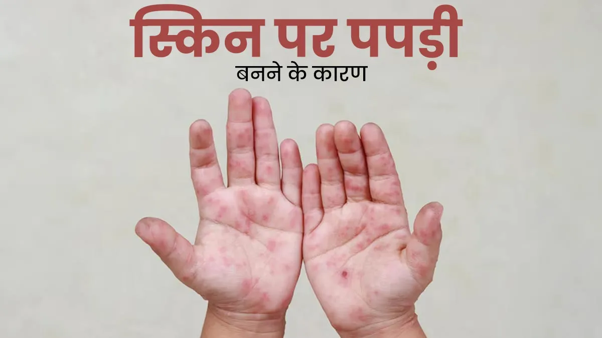 स्किन पर बहुत ज्यादा पपड़ी बनना इक्थियोसिस का हो सकता है संकेत, जानें इसके कारण