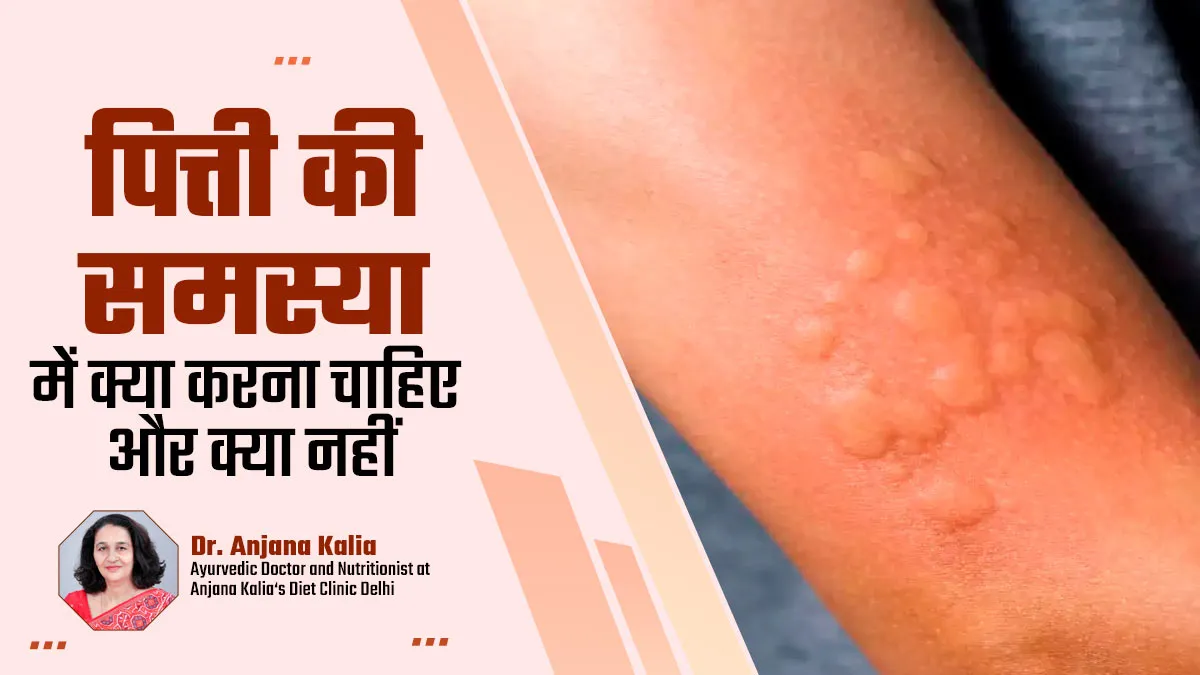 अर्टिकेरिया (त्वचा में पित्ती उछलने) की समस्या में क्या करना चाहिए और क्या नहीं? जानें डॉक्टर से