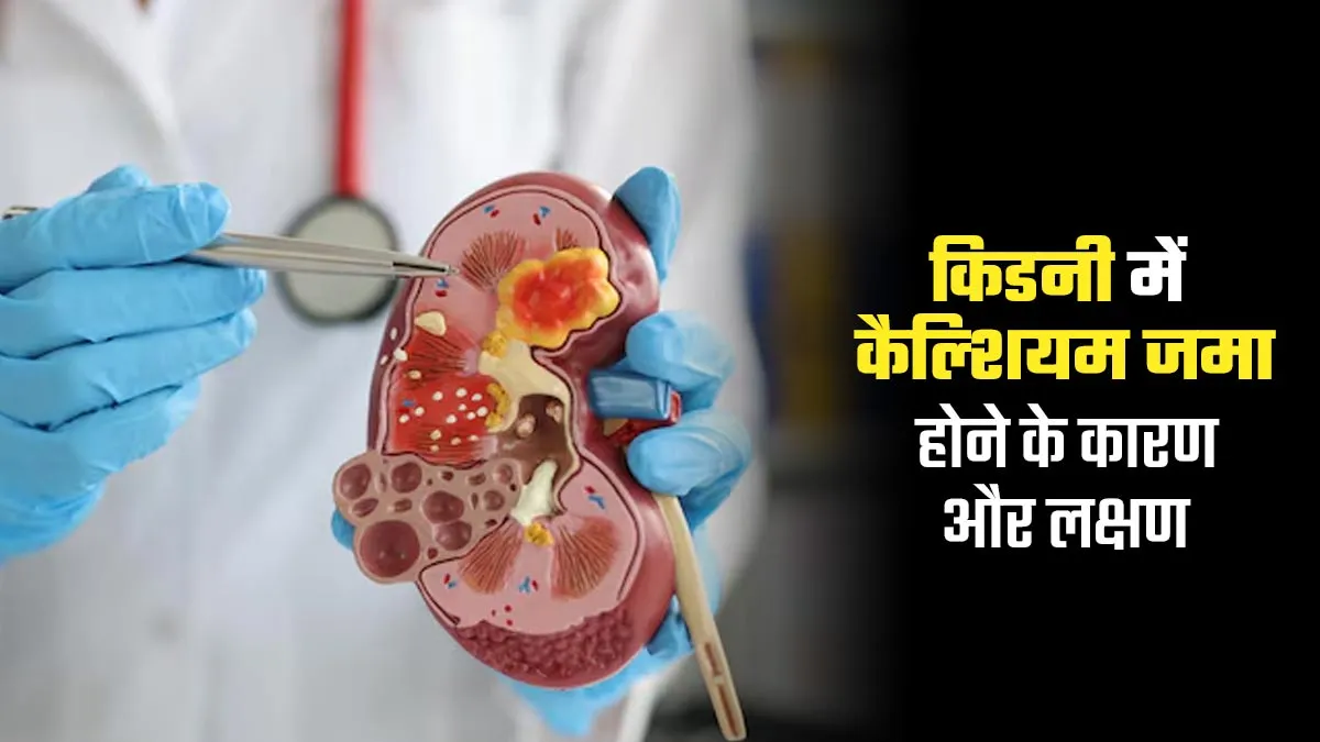 नेफ्रोकैल्सीनोसिस क्या है? जानें किडनी में कैल्शियम के जमाव से जुड़ी इस बीमारी के कारण और लक्षण