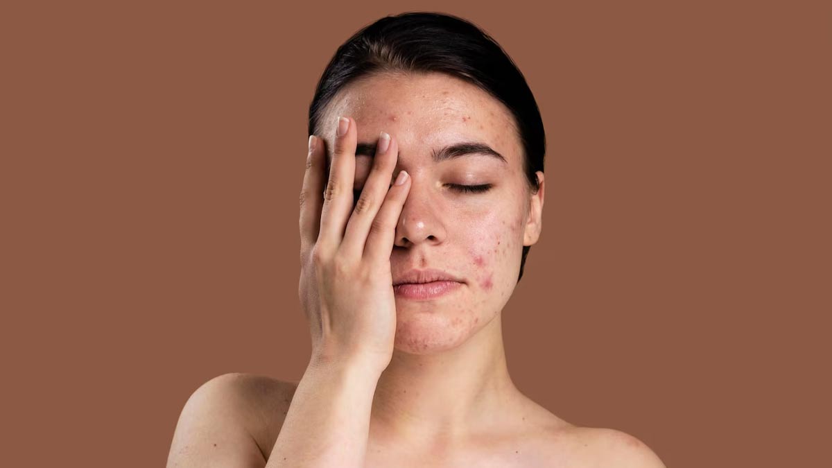 ayurvedic face pack to get relief from acne problem in hindi 01 (3)