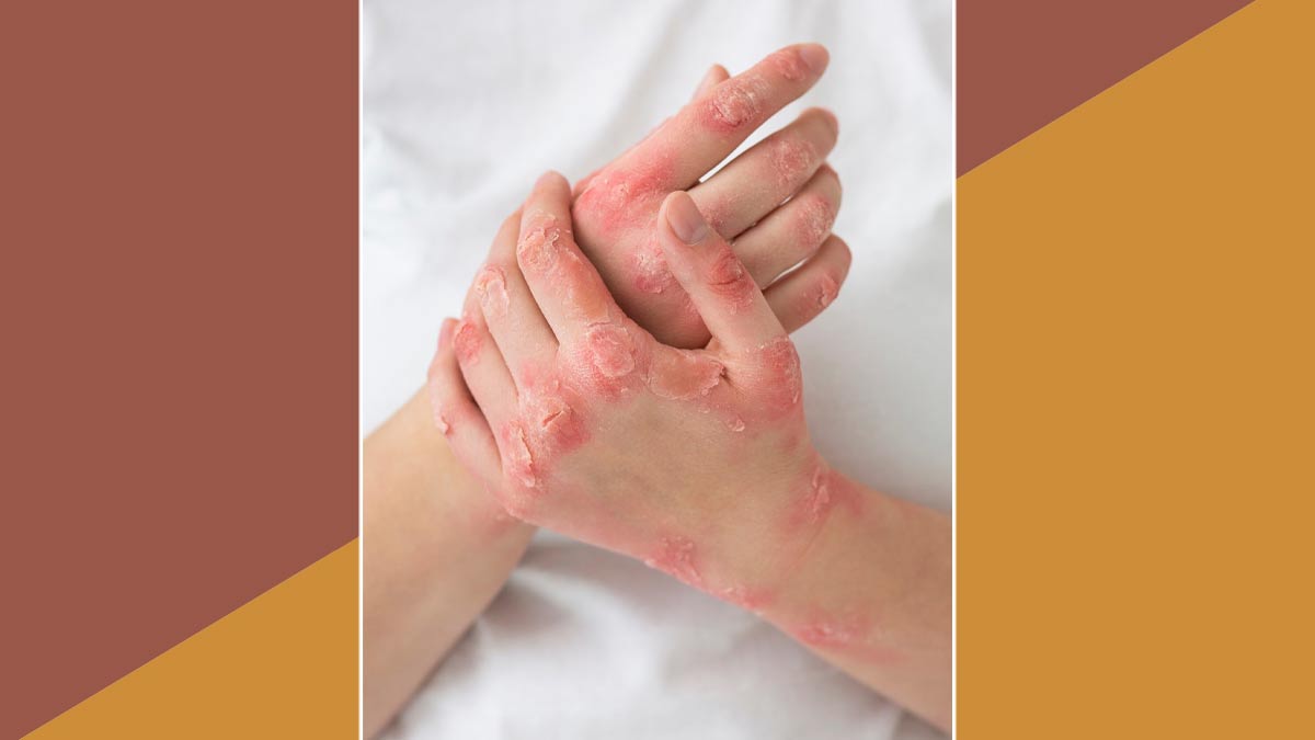 causes-of-Ichthyosis