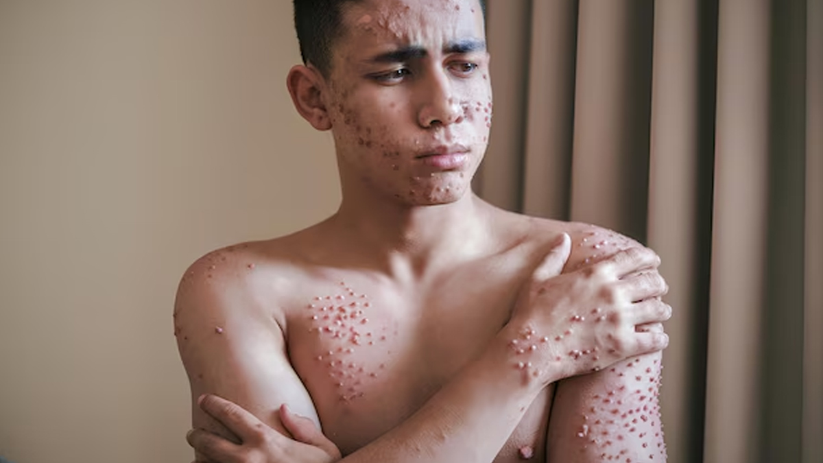 measles-related-doubts