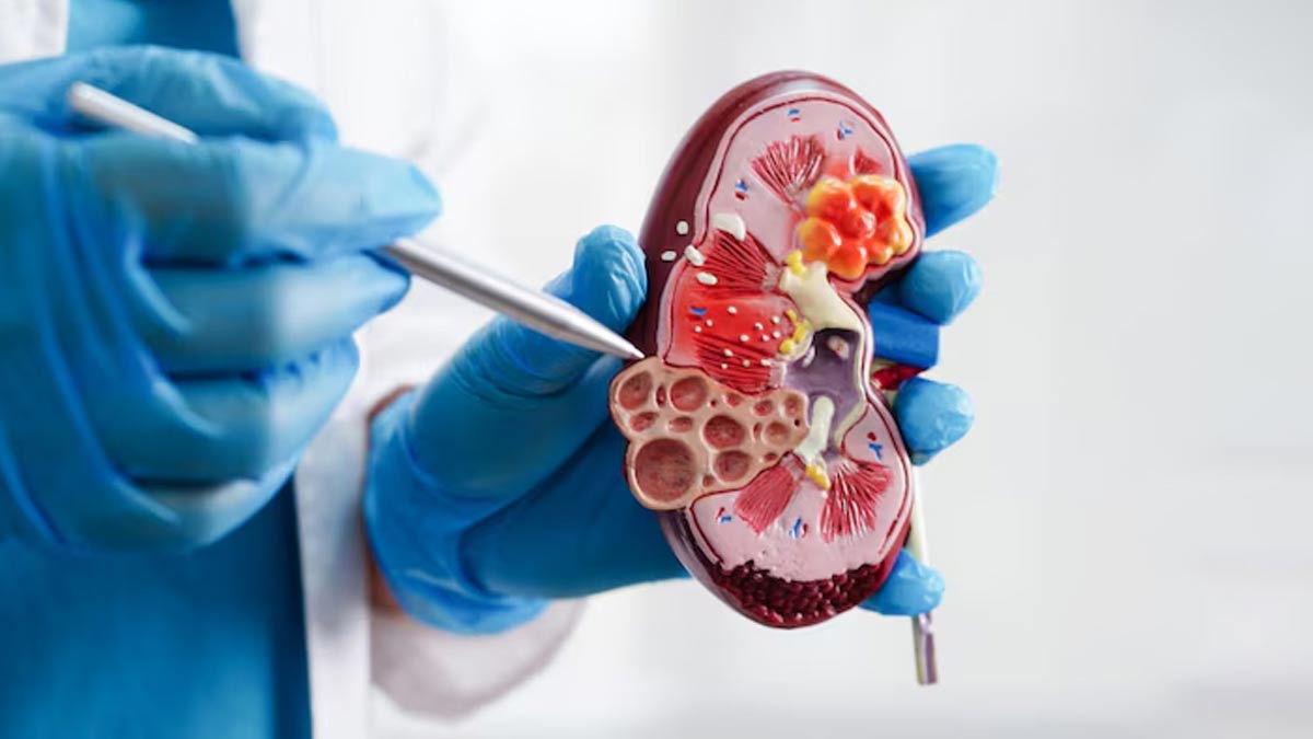nephrocalcinosis-causes-and-symptoms