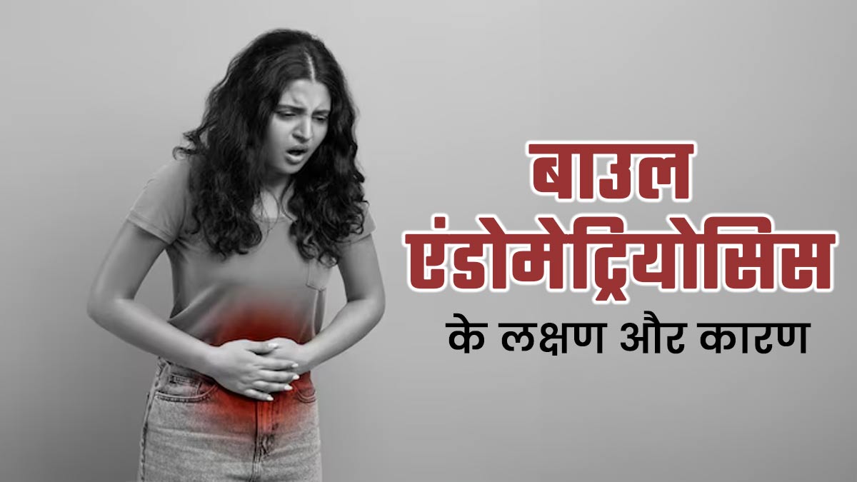 बाउल एंडोमेट्रियोसिस के क्या कारण हो सकते हैं? जानें इसके लक्षण