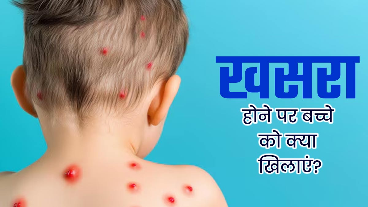 खसरा (Measles) होने पर बच्चे की डाइट कैसी होनी चाहिए? एक्‍सपर्ट से जानें