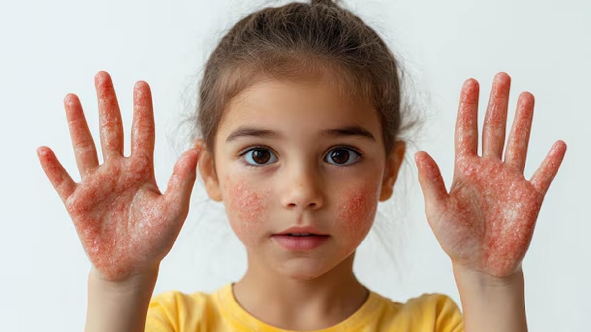 diet-for-child-with-measles