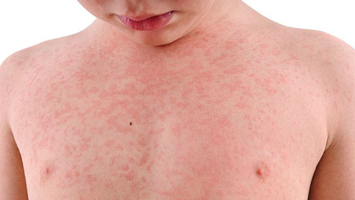 खसरे के लक्षण- Symptoms of Measles measles-inside