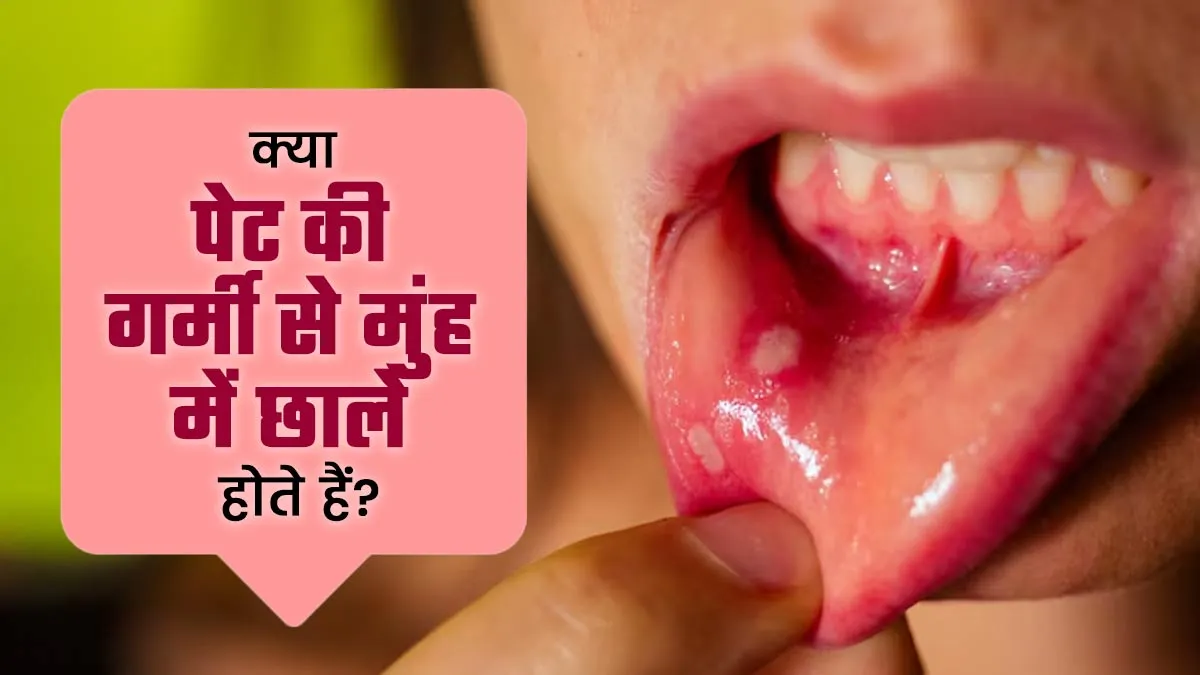 क्या पेट की गर्मी से मुंह में छाले होते हैं? आयुर्वेदाचार्य से जानें