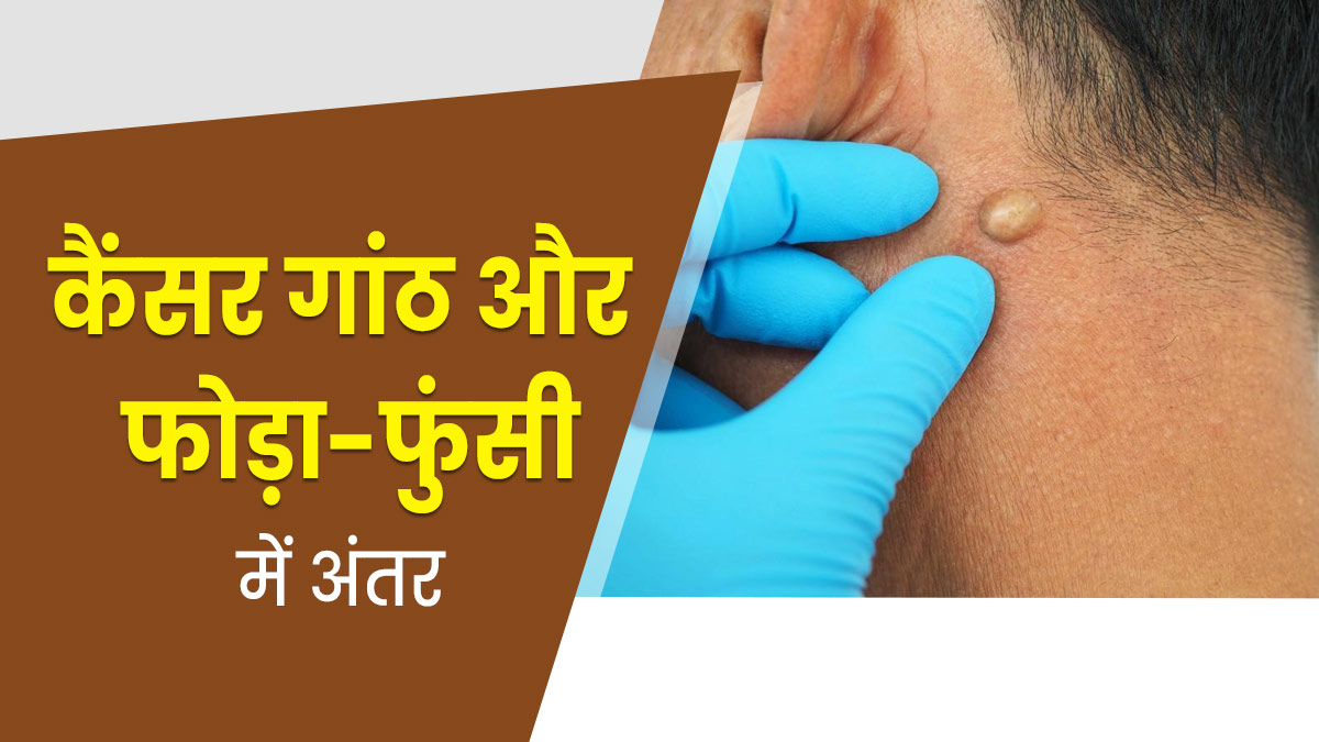 कैंसर की गांठ और फोड़े-फुंसी में अंतर कैसे समझें? डॉक्‍टर से जानें