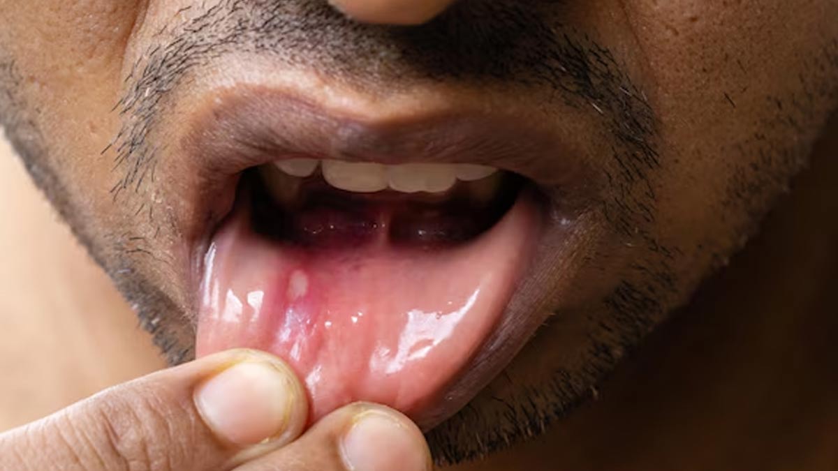 can stomach heat cause mouth ulcers in