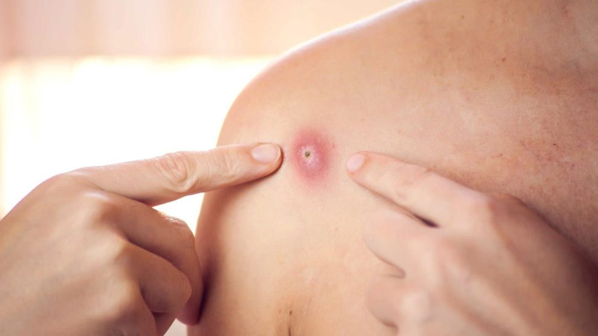 difference-between-cancer-lump-and-cyst