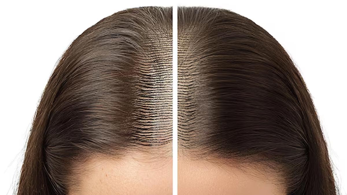 how-to-thicken-thin-hairline