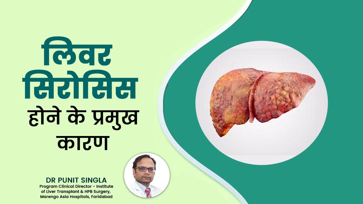 लिवर सिरोसिस होने के प्रमुख 5 कारण क्या हैं, डॉक्टर से जानें कैसे कर सकते हैं इससे बचाव