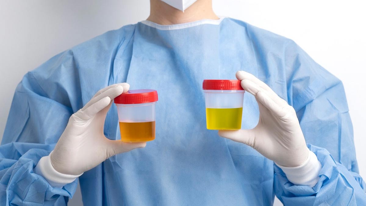 link between urine and dehydration