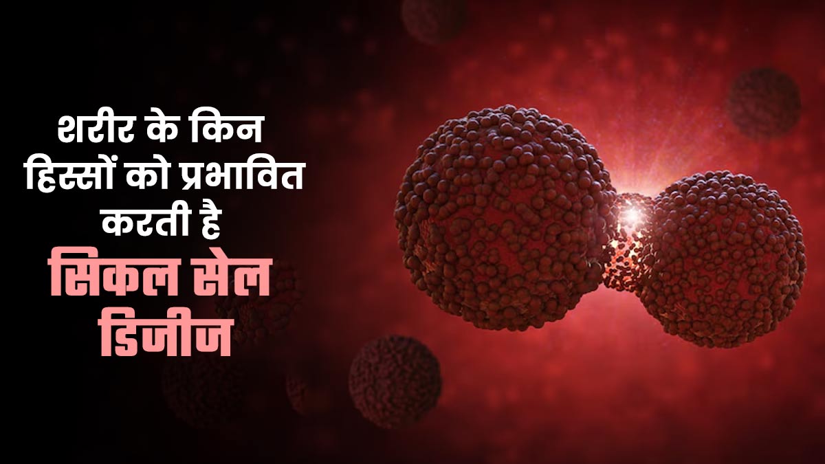 सिकल सेल डिजीज शरीर के किन अंगों को प्रभावित करती है? डॉक्टर से जानें