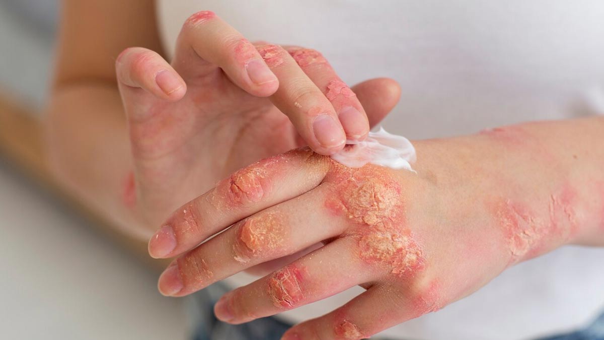 Causes and symptoms of shingles in pregnancy in