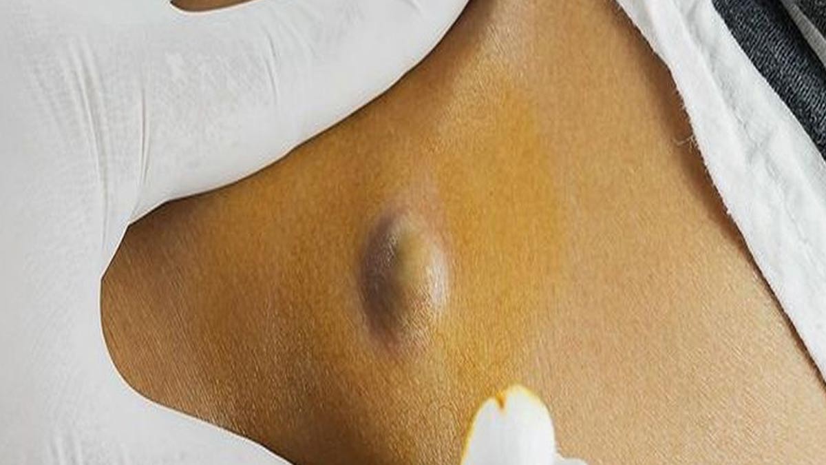 शरीर पर छोटी-छोटी गांठ बनने के मुख्य कारण- Reasons of Formation of small lumps on the Body ins2-skin-lump