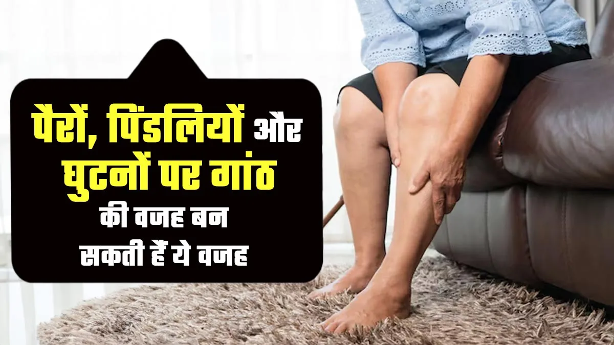 पैरों, पिंडलियों और घुटनों पर गांठ की वजह बन सकता है Erythema Nodosum, जानें इसके कारण और लक्षण
