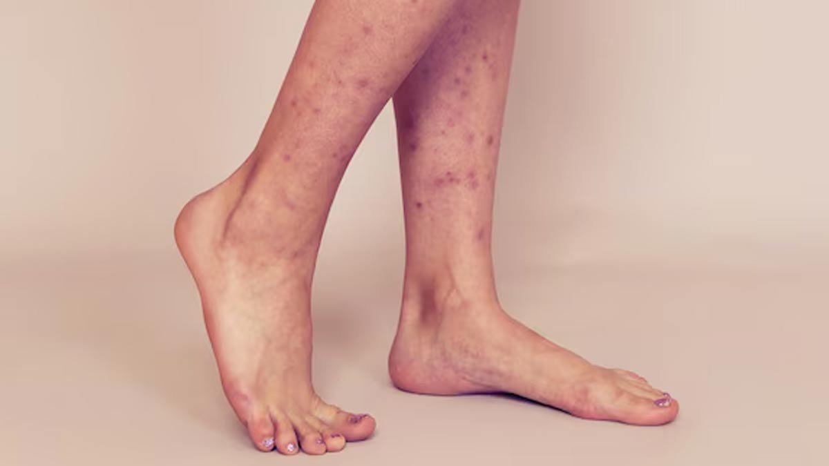 causes of leg acne know the prevention tips 01 (8)
