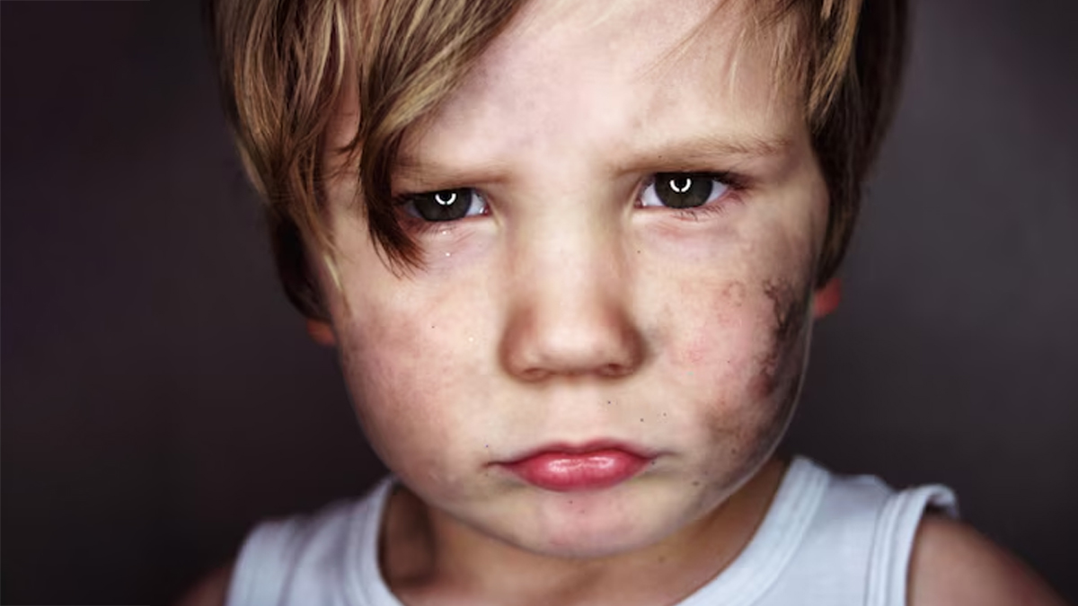 pigmentation-in-kids