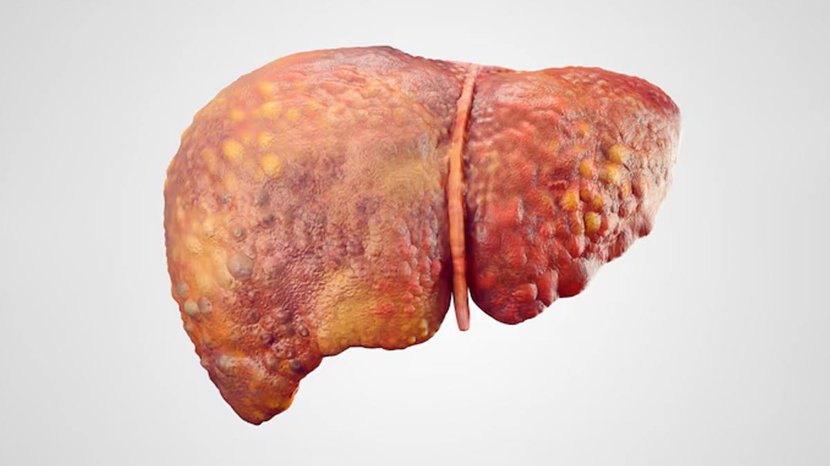 home remedies for fatty liver in hindi  01 (3)