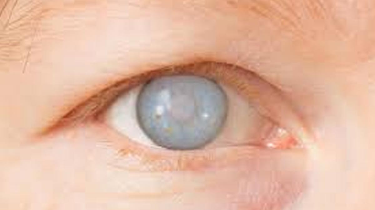 युवाओं में मोतियाबिंद के बढ़ते मामलों का कारण- Reasons behind rising cases of cataract among youth Cataracts-inside
