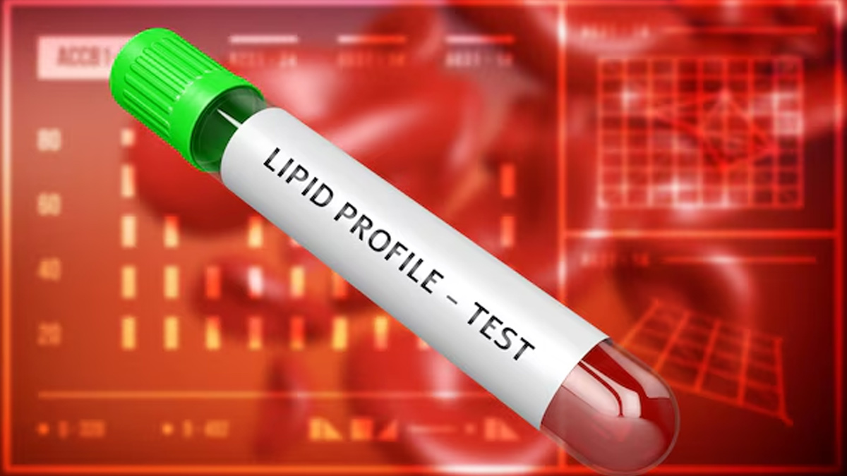 lipid-profile-test