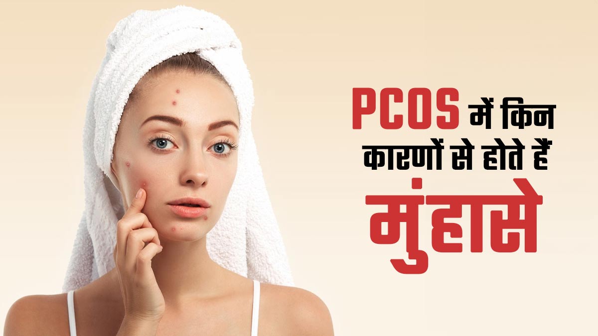 PCOS में किन कारणों से होते हैं मुंहासे, जानें इसके लक्षण और बचाव का तरीका