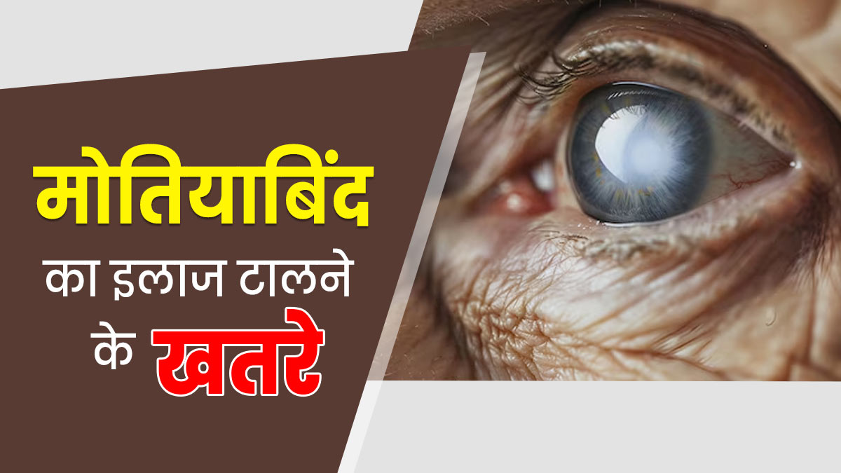 मोतियाबिंद का इलाज टालने से क्या खतरा हो सकता है? डॉक्‍टर से जानें