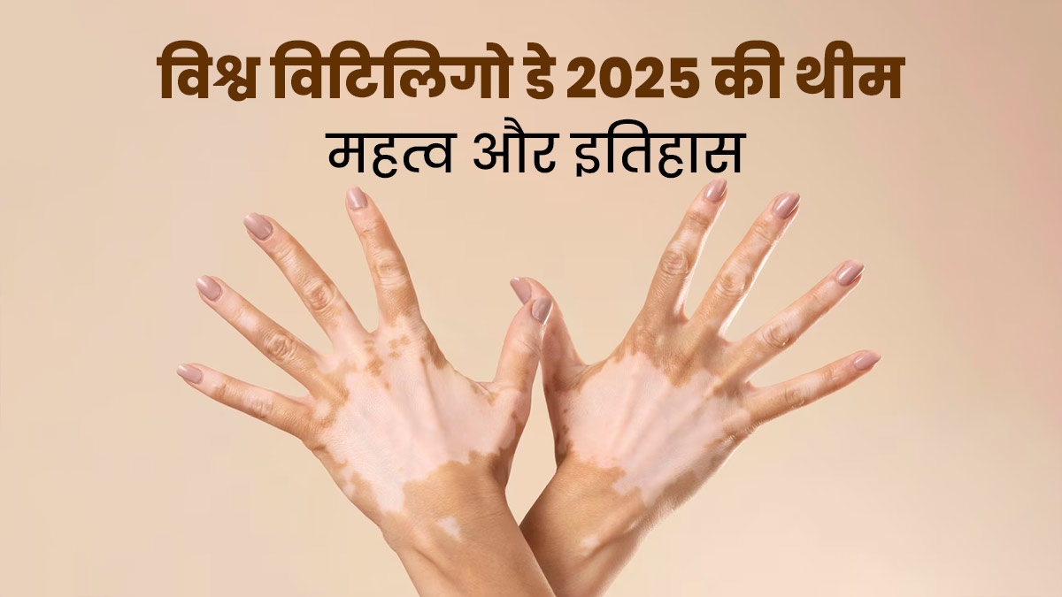 World Vitiligo Day 2025: क्यों मनाया जाता है वर्ल्ड विटिलिगो डे? जानें इस साल की थीम और महत्व