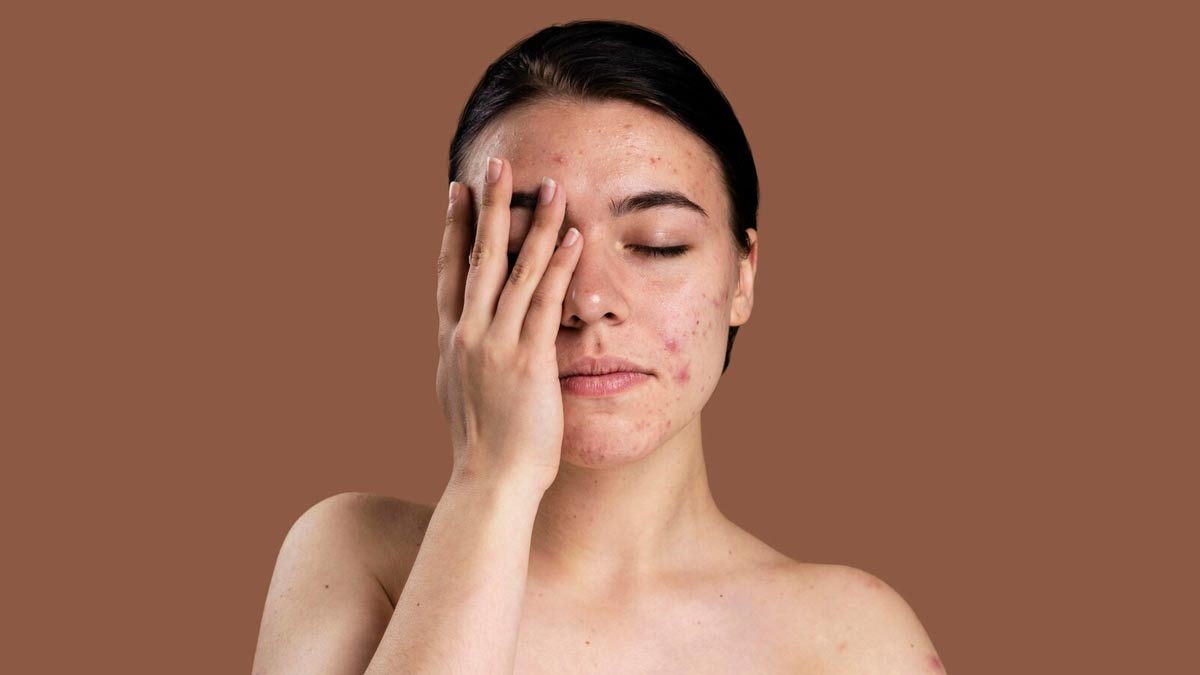 Causes and symptoms of pcos acne in