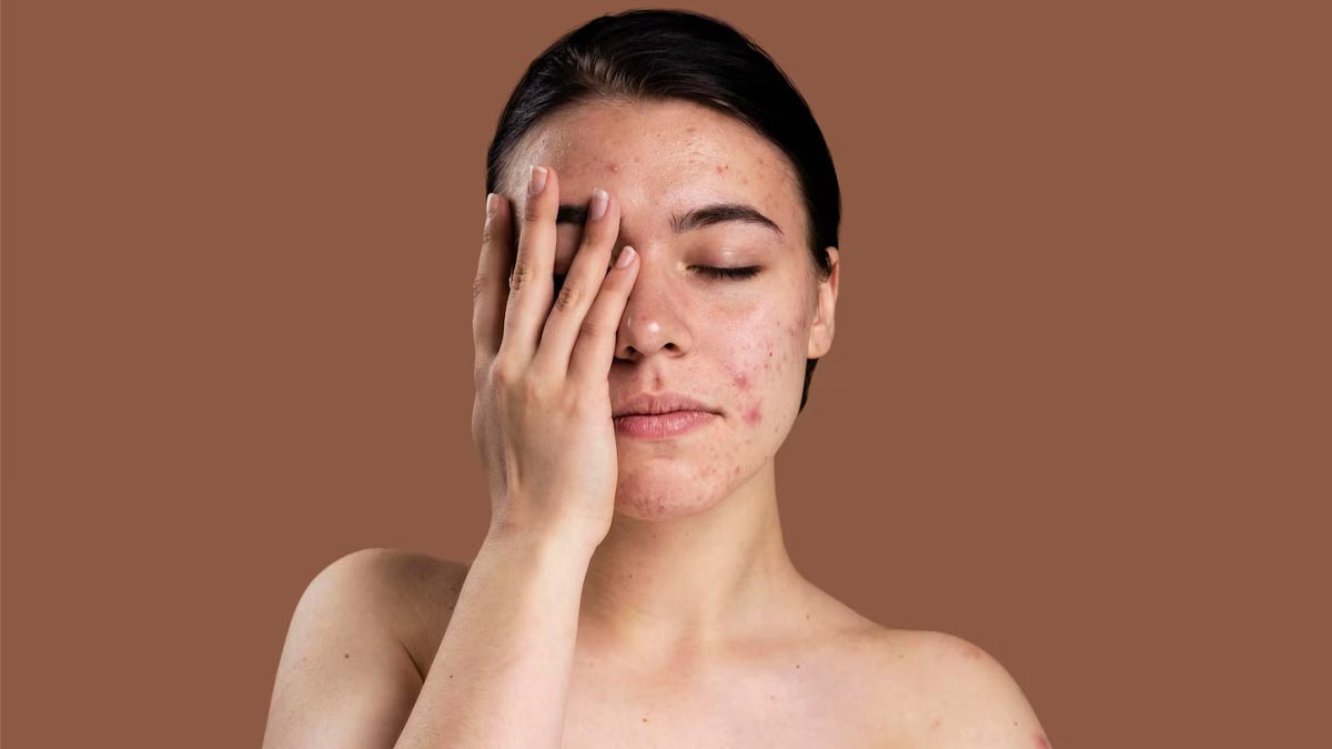 Tips-to-prevent-acne-before-your-period-inside