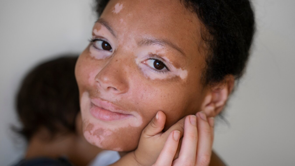 world-vitiligo-day-2025