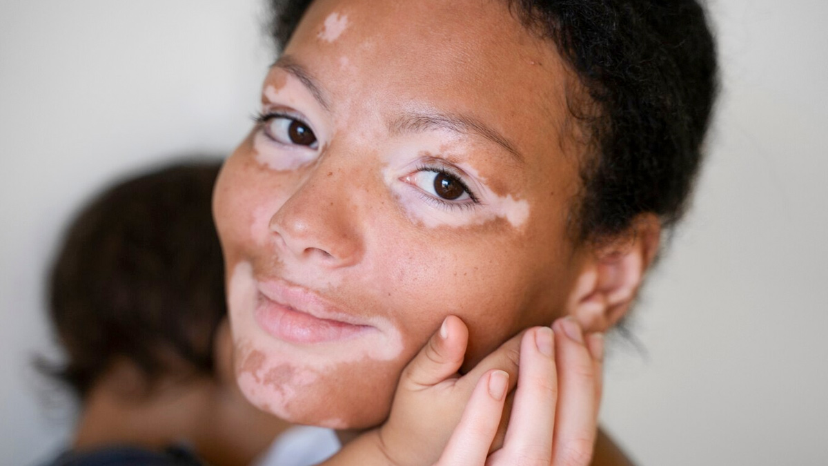 World Vitiligo Day 2025 : सफेद दाग का इलाज क्या है? डॉक्टर से जानें