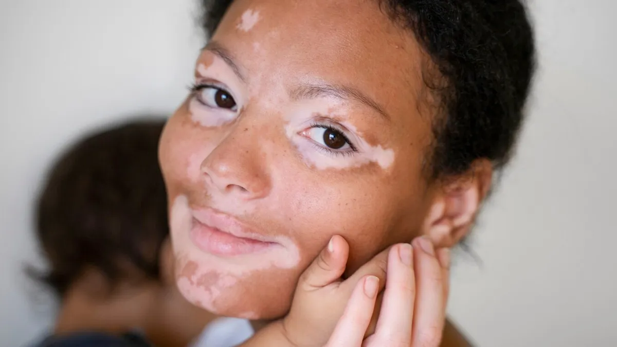World Vitiligo Day 2025 : सफेद दाग का इलाज क्या है? डॉक्टर से जानें