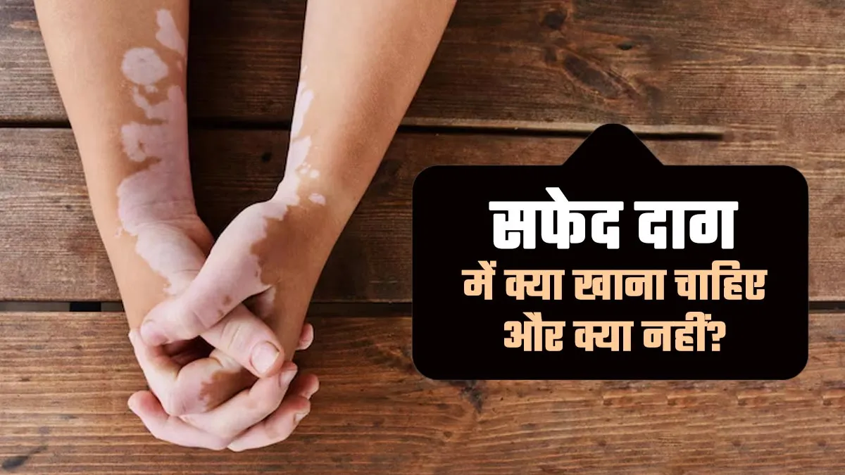 World Vitiligo Day 2025: सफेद दाग की समस्या में क्या खाना चाहिए और क्या नहीं? आयुर्वेदिक डॉक्टर से जानें