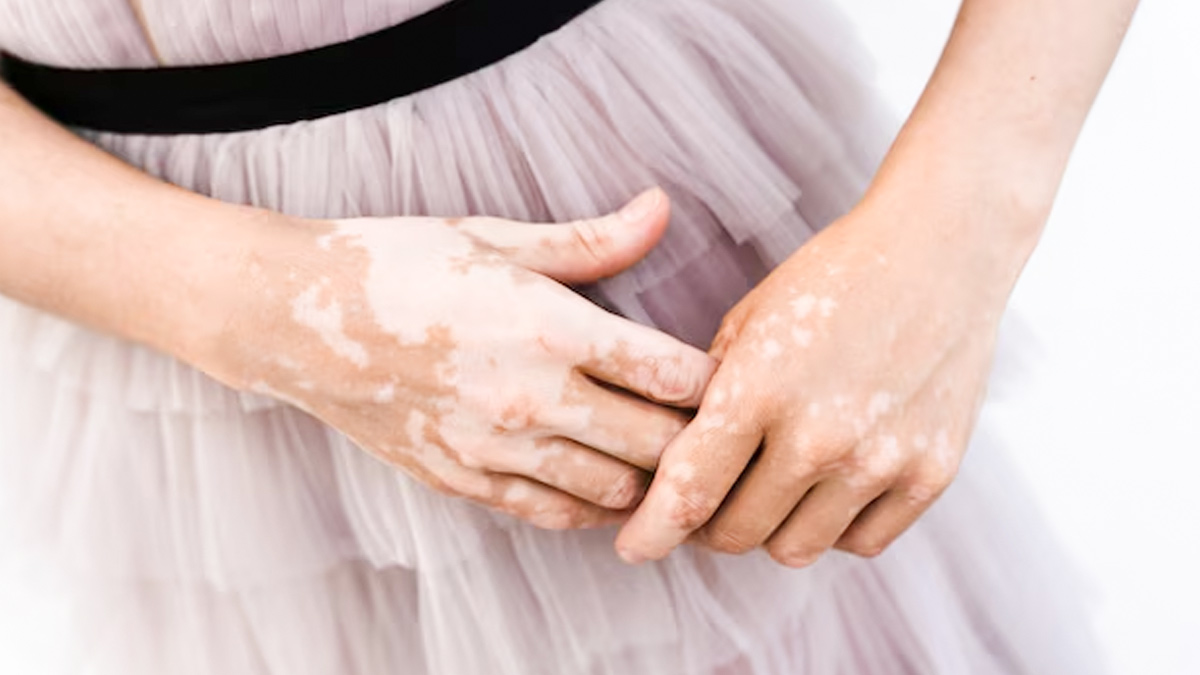 सफेद दाग का इलाज क्या है? डॉक्टर से जानें| Medical Treatment For White Patches on skin | Safed daag ka Ilaj kya hai | Safed Daag kyu hota hai | Safed Daag Kaise Theek Karen Safed-daag-inside2