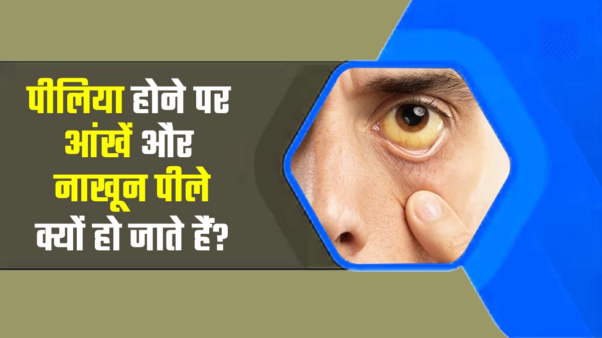 पीलिया होने पर आंखें और नाखून पीले क्यों हो जाते हैं? डॉक्टर से समझें