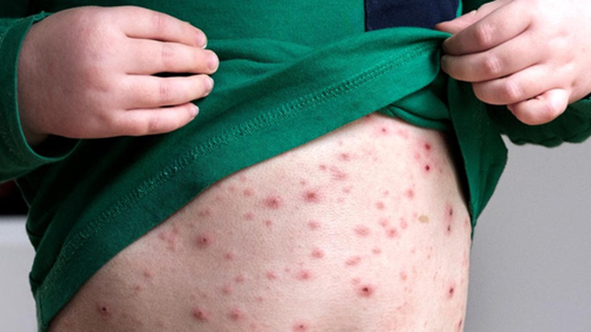 red-rashes-on-kids-stomach