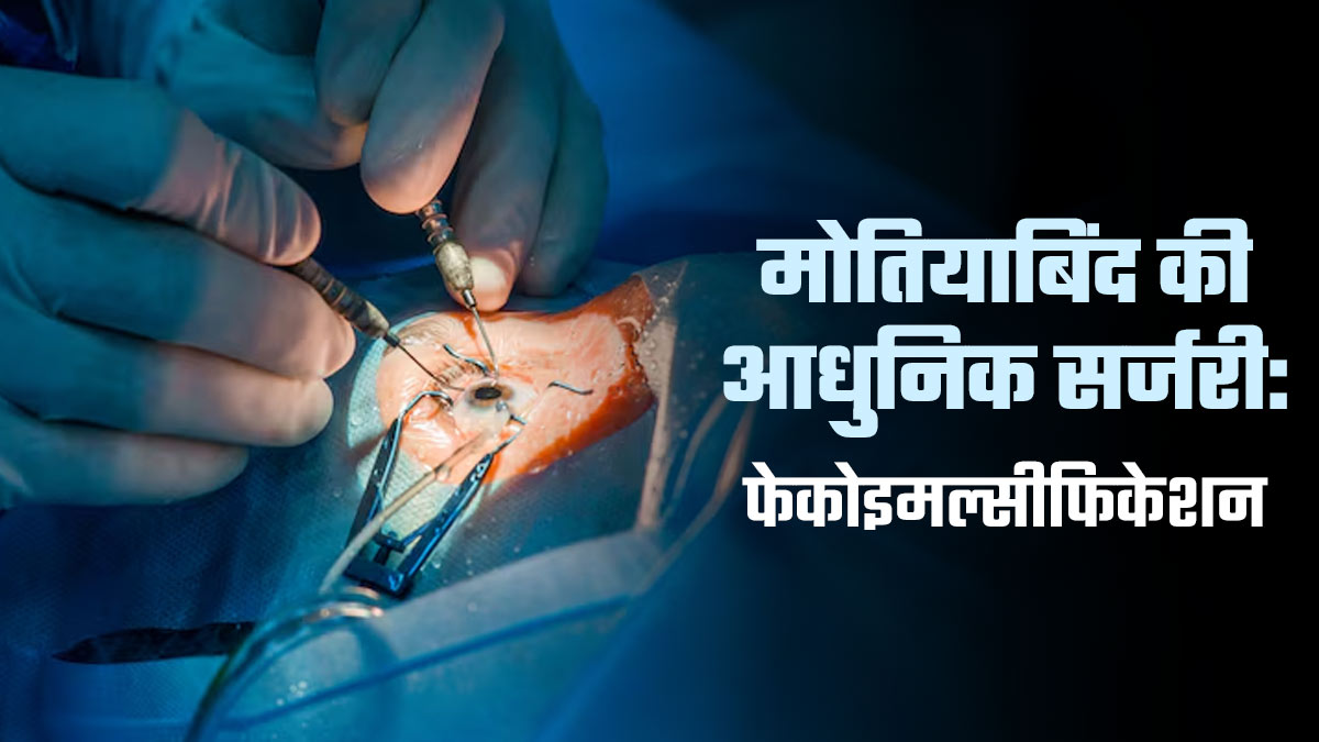 मोत‍ियाब‍िंद की आधुन‍िक सर्जरी 'फेकोइमल्सीफिकेशन' क्‍या है? डॉक्‍टर से जानें प्रक्र‍िया, फायदे