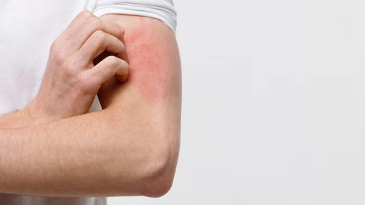 ayurvedic remedies for scabies in hindi 01 (3)