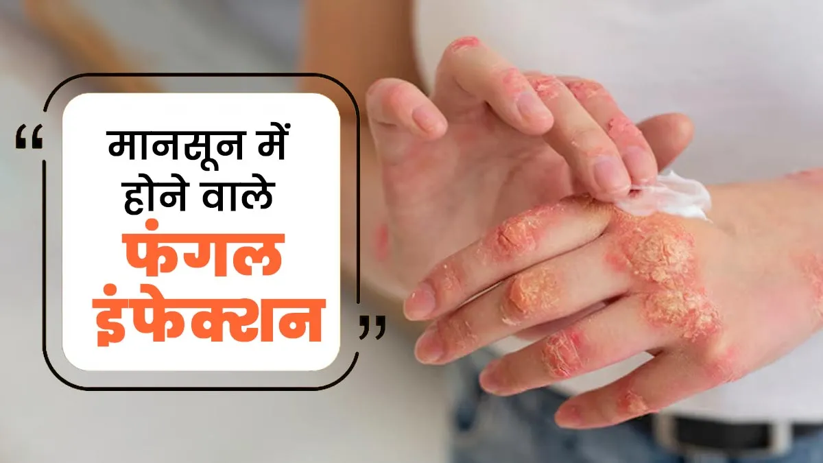 मानसून में कौन-कौन से फंगल इंफेक्शन होते हैं? डॉक्टर से जानें