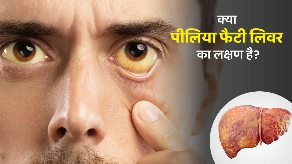 क्या पीलिया फैटी लिवर का लक्षण है? डॉक्टर से जानें