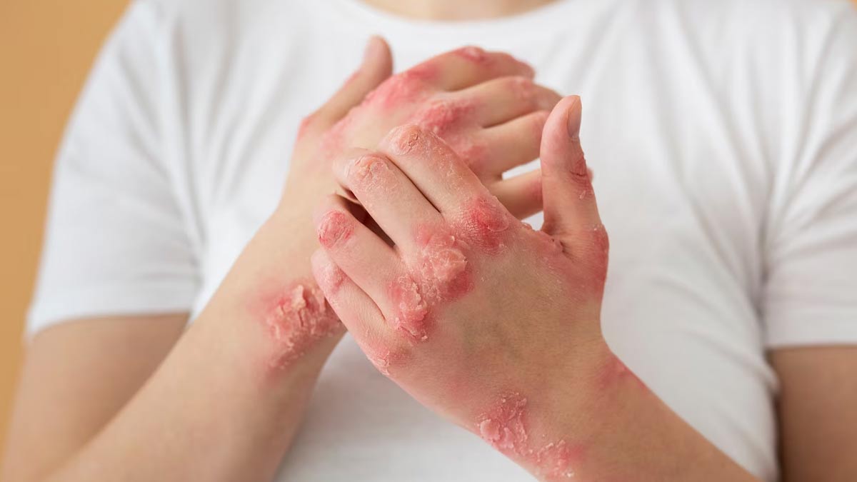 Fungal-infection-during-rainy-season