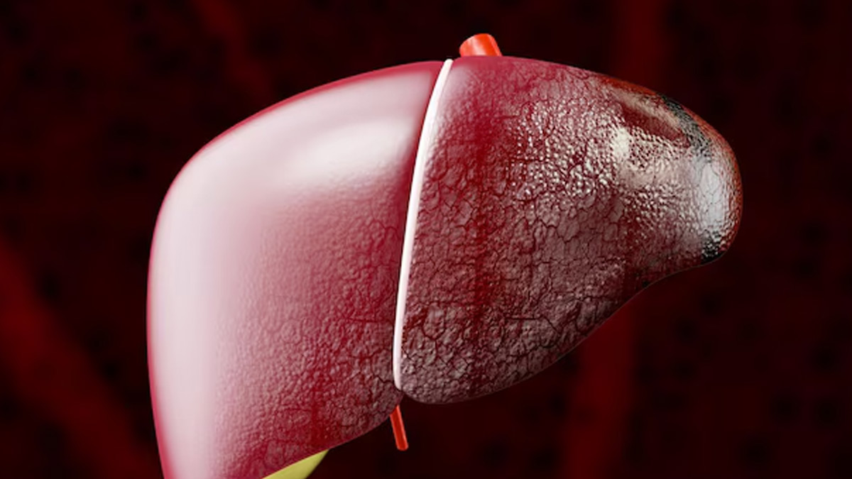 is jaundice a symptom of fatty liver in hindi 1