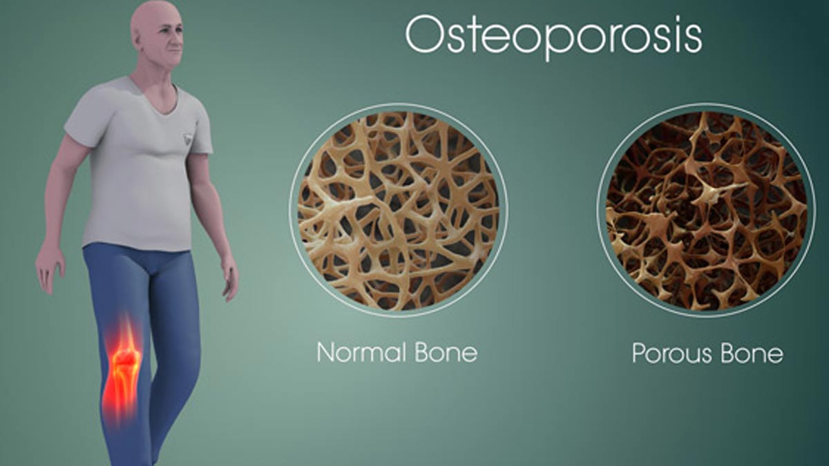 is osteoporosis genetic in hindi 01 (3)