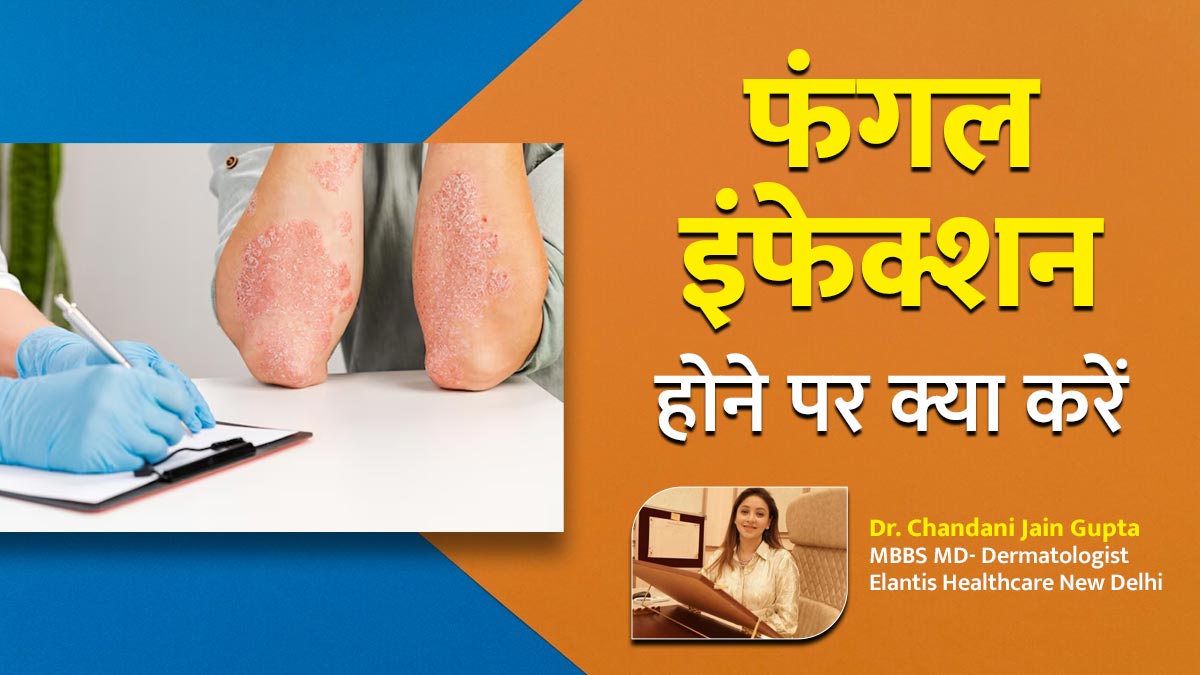 फंगल इंफेक्शन होने पर क्या करें और क्या नहीं? जानें स्किन केयर एक्सपर्ट से