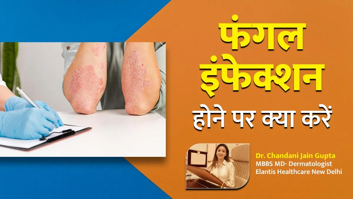 फंगल इंफेक्शन होने पर क्या करें और क्या नहीं? जानें स्किन केयर एक्सपर्ट से