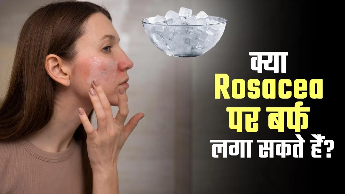 क्या स्किन प्रॉब्लम रोजेशिया (Rosacea) पर बर्फ लगाया जाना सेफ होता है? बता रहे हैं डॉक्टर
