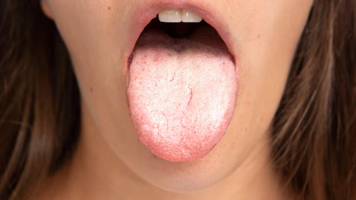 causes and symptoms of yellow tongue in